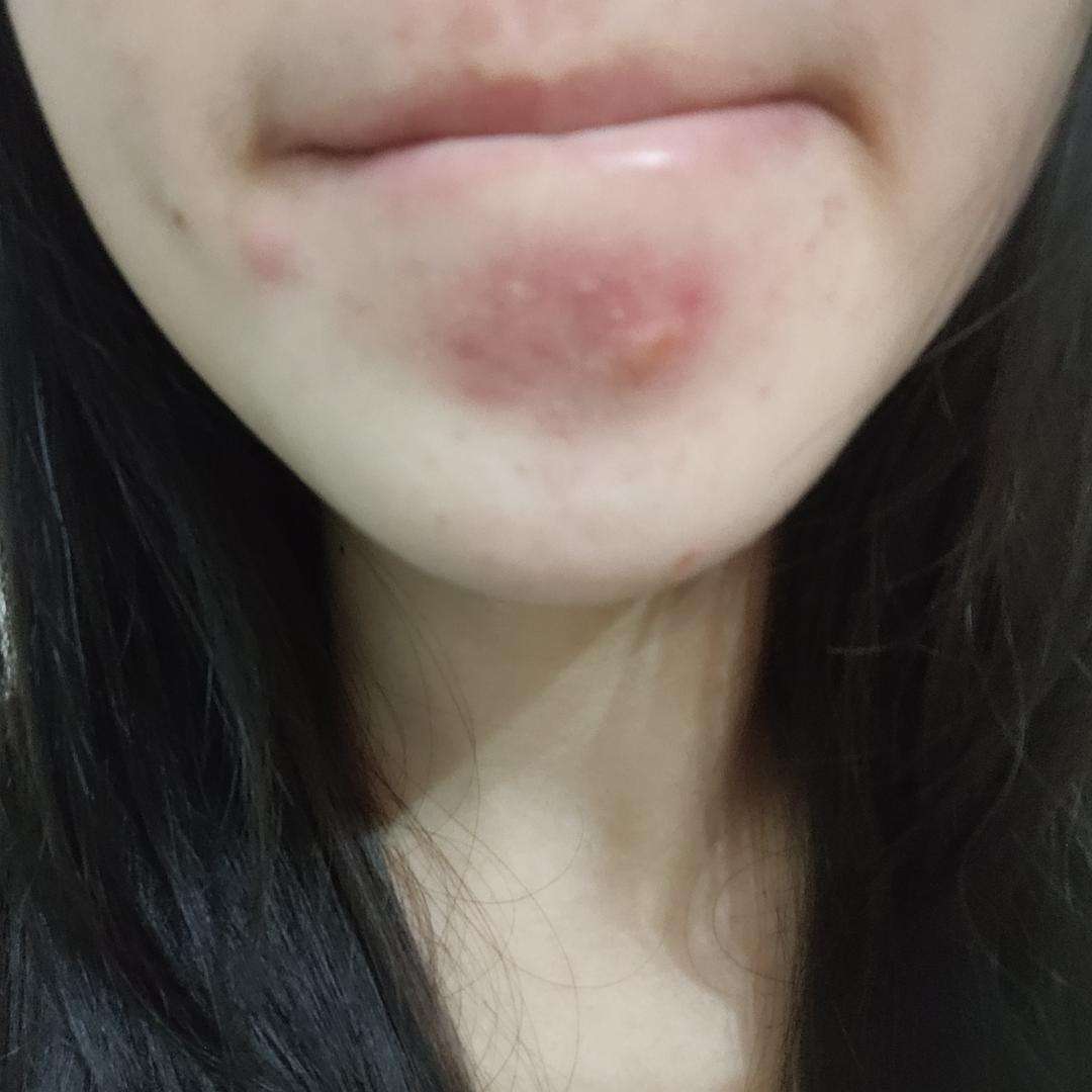 痘痘