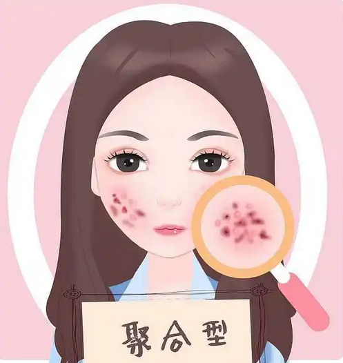 痤疮