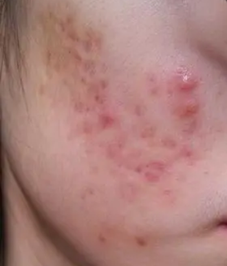痘痘