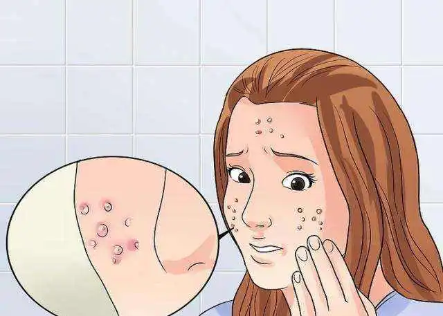 痘痘