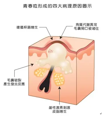痘痘